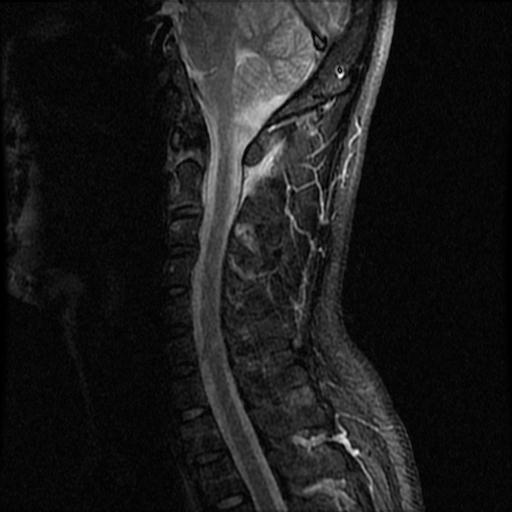 File:Axis fracture - MRI (Radiopaedia 71925-82375 Sagittal STIR 4).jpg