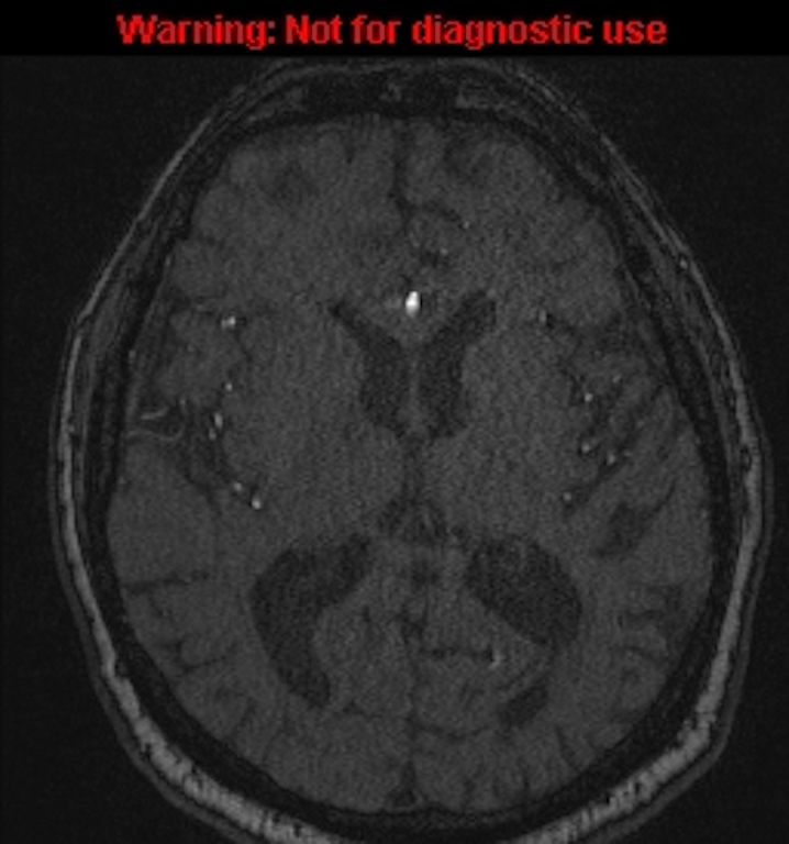 Azygos anterior cerebral artery (Radiopaedia 59325-66677 Axial MRA 95).jpg