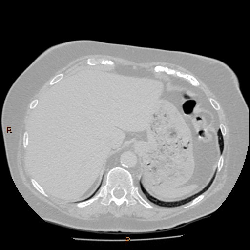 Azygos lobe (Radiopaedia 40161-42821 Axial lung window 65).jpg