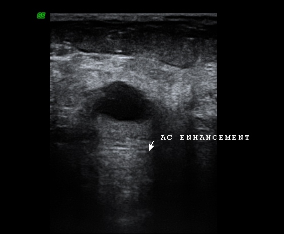 File:BIRADS II lesion - simple breast cyst (Radiopaedia 16526-16208 Transverse 1).JPG