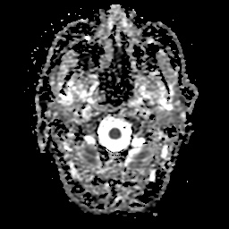 File:Balo concentric sclerosis (Radiopaedia 53875-59982 Axial ADC 2).jpg