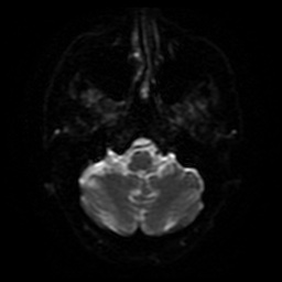 File:Balo concentric sclerosis (Radiopaedia 53875-59982 Axial DWI 29).jpg