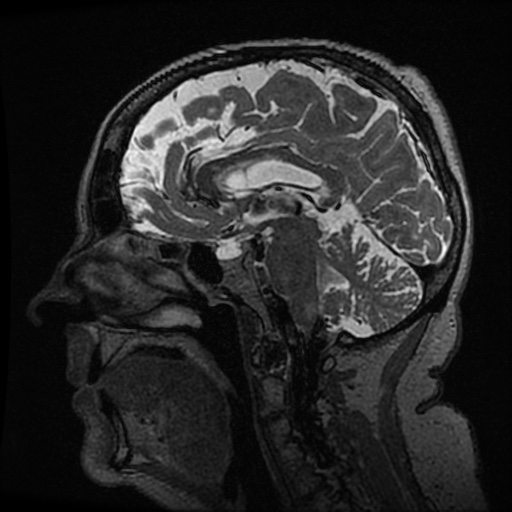 Balo concentric sclerosis (Radiopaedia 53875-59982 Sagittal 3D FSE 135).jpg