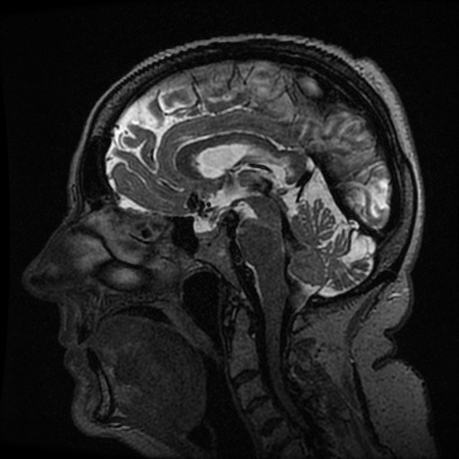 Balo concentric sclerosis (Radiopaedia 53875-59982 Sagittal 3D FSE 144).jpg