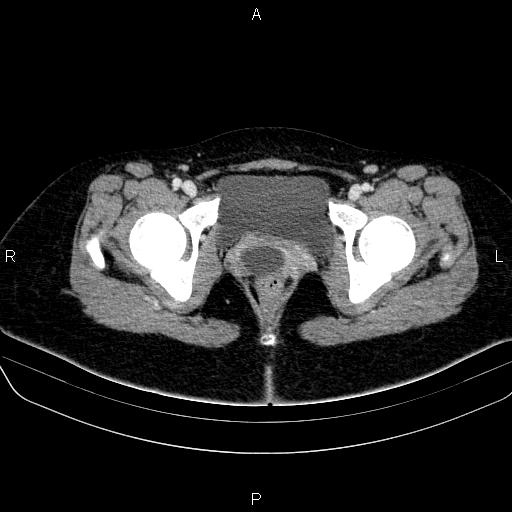 File:Bartholin gland cyst (Radiopaedia 62635-70930 Axial Post contrast 71).jpg
