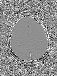 Base of skull chondrosarcoma (Radiopaedia 30410-31070 Axial SWI Phase 46).jpg