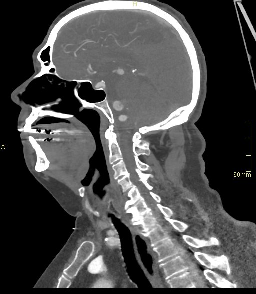 Basilar artery aneurysm (Radiopaedia 56261-62932 C 27).jpg