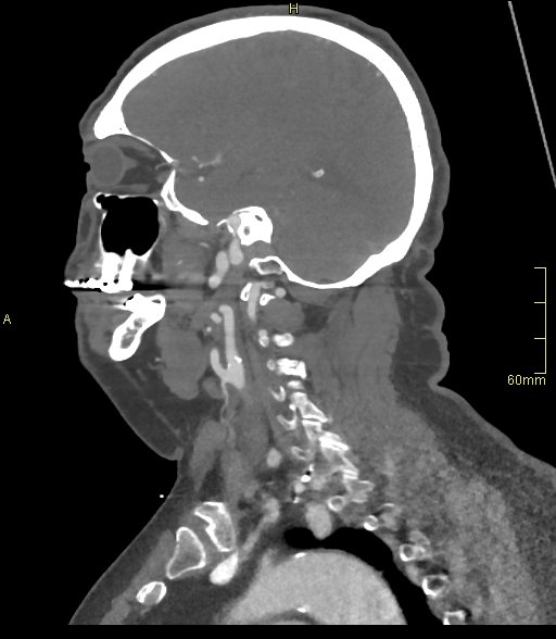 Basilar artery aneurysm (Radiopaedia 56261-62932 C 49).jpg