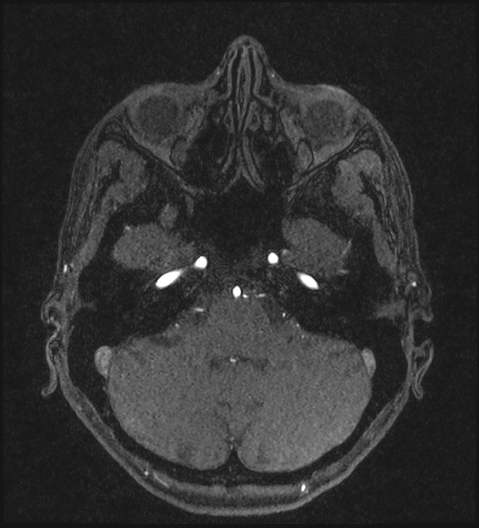 Basilar artery perforator aneurysm (Radiopaedia 82455-97733 Axial MRA 61).jpg