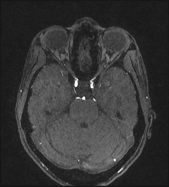 Basilar artery perforator aneurysm (Radiopaedia 82455-97733 Axial MRA 88).jpg