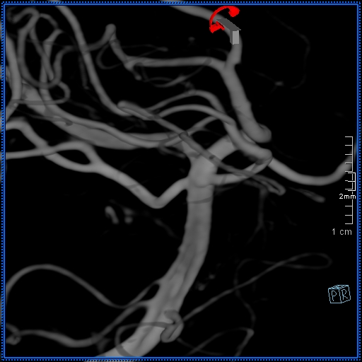 Basilar artery perforator aneurysm (Radiopaedia 82455-99524 3D Left VA 77).jpg