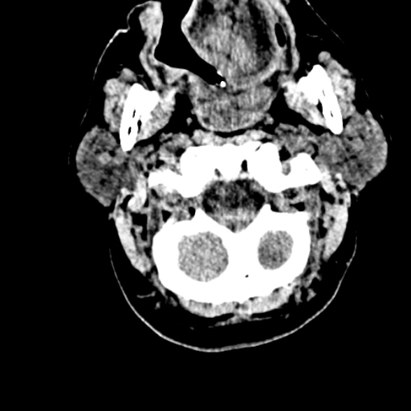 Basilar artery thrombosis (Radiopaedia 53351-59352 Axial non-contrast 14).jpg