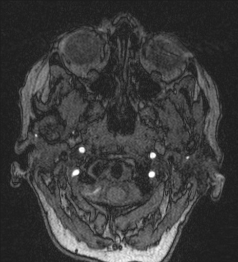 Basilar tip aneurysm (Radiopaedia 26504-26632 MRA 6).jpg