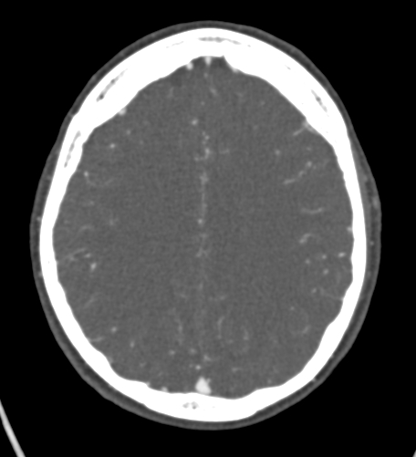 Basilar tip aneurysm with coiling (Radiopaedia 53912-60086 A 103).jpg