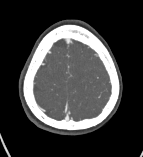 Basilar tip aneurysm with coiling (Radiopaedia 53912-60086 A 127).jpg