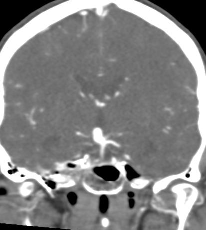 Basilar tip aneurysm with coiling (Radiopaedia 53912-60086 B 74).jpg