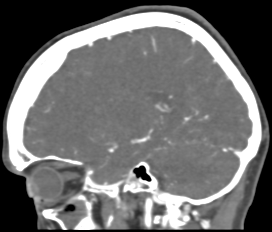 Basilar tip aneurysm with coiling (Radiopaedia 53912-60086 C 88).jpg