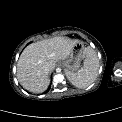Beckwith-Wiedeman syndrome with bilateral Wilms tumors (Radiopaedia 60850-68629 A 42).jpg