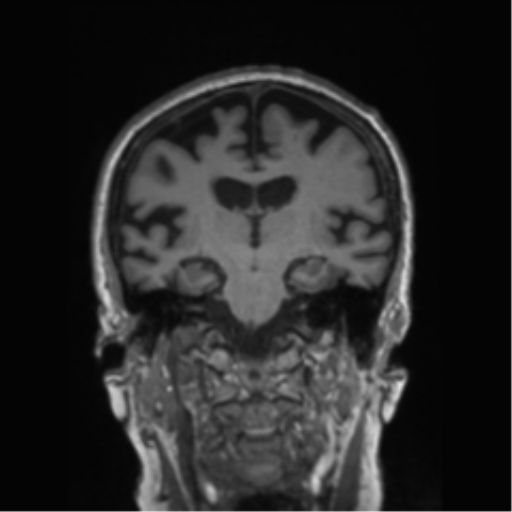 Behavioral variant frontotemporal dementia and late onset schizophrenia (Radiopaedia 52197-58083 Coronal T1 47).png
