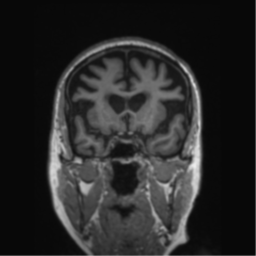 Behavioral variant frontotemporal dementia and late onset schizophrenia (Radiopaedia 52197-58083 Coronal T1 61).png