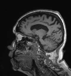 File:Behavioral variant frontotemporal dementia and late onset schizophrenia (Radiopaedia 52197-58083 Sagittal T1 61).png