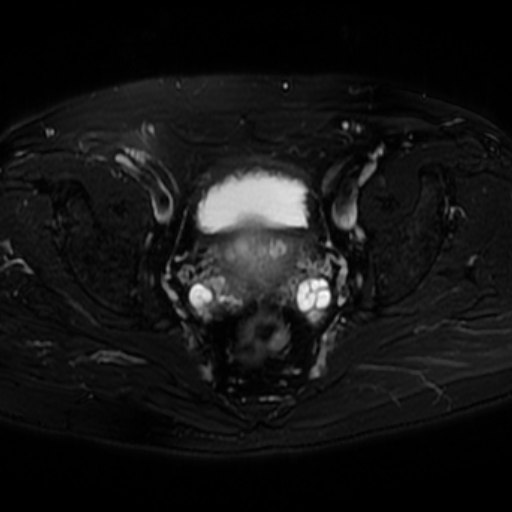 File:Benign prostatic nodular hyperplasia (Radiopaedia 16917-16634 Axial T2 fat sat 4).jpg