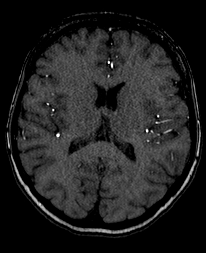 File:Berry aneurysm of the terminal internal carotid artery (Radiopaedia 88286-104918 Axial TOF 140).jpg