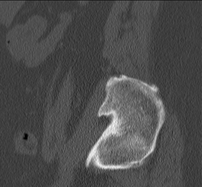 Bertolotti syndrome (Radiopaedia 24864-25128 Sagittal bone window 55).jpg