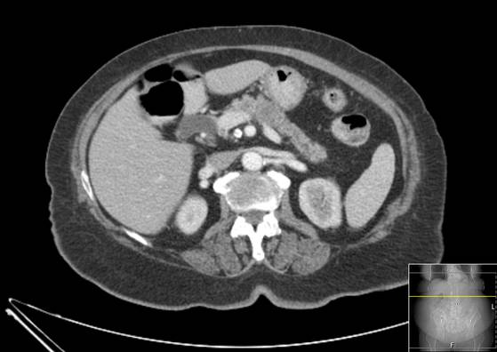 Bicameral celiacomesenteric aneurysm (Radiopaedia 55766-62327 A 22).jpg