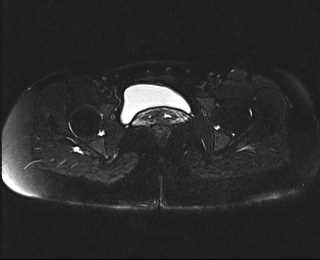 File:Bicornuate bicollis uterus (Radiopaedia 61626-69616 Axial PD fat sat 27).jpg