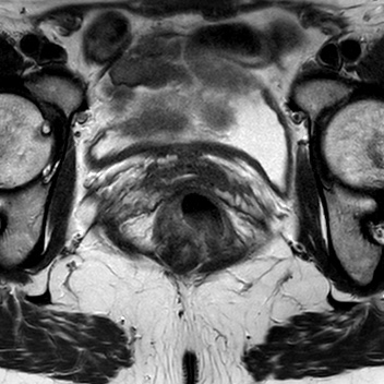 File:Bicornuate uterus (Radiopaedia 61974-70046 Axial T2 21).jpg
