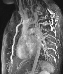 File:Bicuspid aortic valve with aortic coarctation (Radiopaedia 29895-30410 C 1).jpg