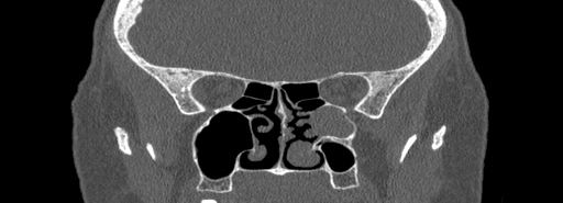 Bilateral Ectopic Infraorbital Nerves (Radiopaedia 49006-54084 Coronal bone window 50).jpg
