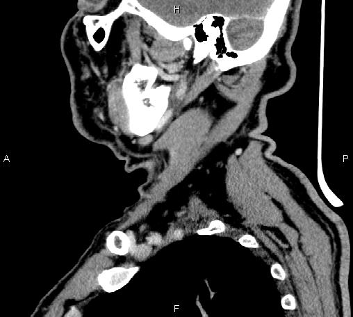 Bilateral Warthin tumors (Radiopaedia 84034-99263 D 58).jpg