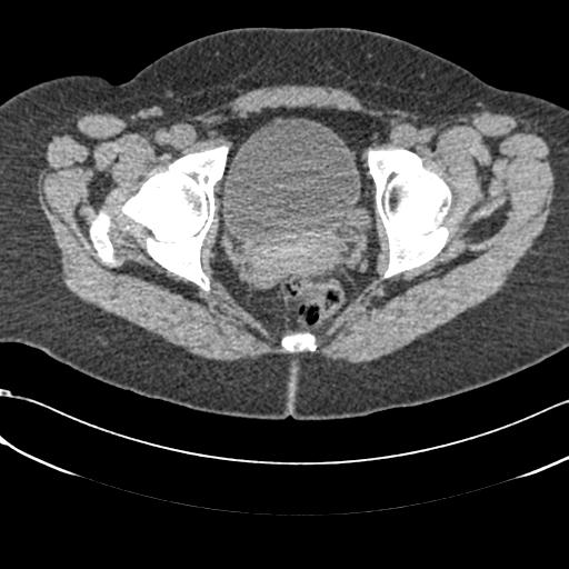 File:Bilateral acetabular protrusion with pincer type femoro-acetabular impingement (Radiopaedia 30134-30733 AXIAL SOFT THIN 43).jpg