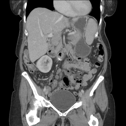 Bilateral adrenal granulocytic sarcomas (chloromas) (Radiopaedia 78375-91007 B 41).jpg