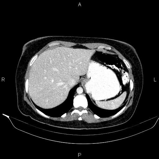 File:Bilateral adrenal myelolipoma (Radiopaedia 63058-71535 B 27).jpg