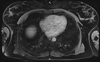 File:Bilateral adrenal myelolipoma (Radiopaedia 63058-71537 H 5).jpg
