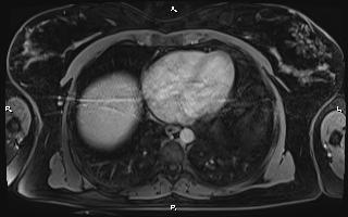 File:Bilateral adrenal myelolipoma (Radiopaedia 63058-71537 H 8).jpg