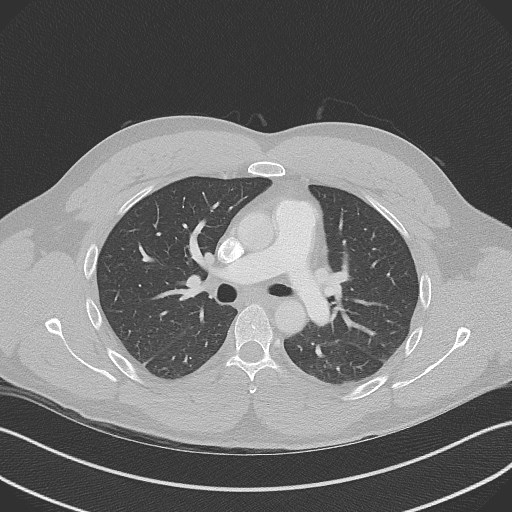 File:Bilateral atelectasis (Radiopaedia 48666-53675 Axial lung window 48).jpg