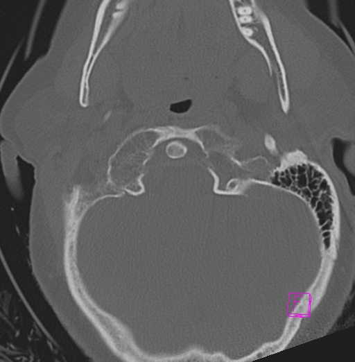 File:Bilateral atlanto-occipital assimilation (Radiopaedia 28350-28603 Axial bone window 6).jpg