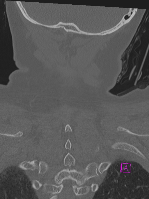 Bilateral atlanto-occipital assimilation (Radiopaedia 28350-28603 Coronal bone window 45).jpg