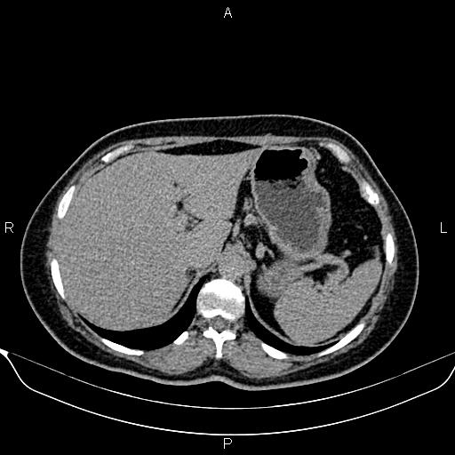 File:Bilateral benign adrenal adenomas (Radiopaedia 86912-103124 Axial C+ delayed 20).jpg