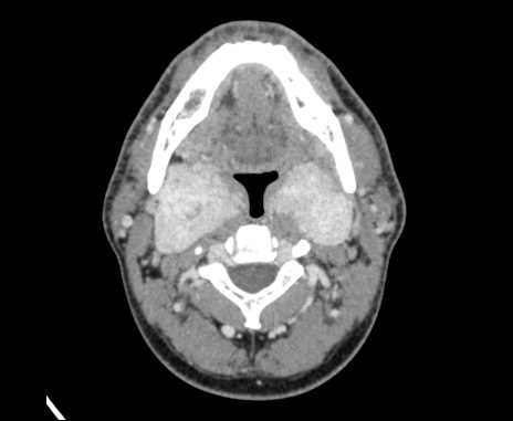 Bilateral carotid body tumors (Radiopaedia 61841-69870 Axial Post contrast 38).jpg