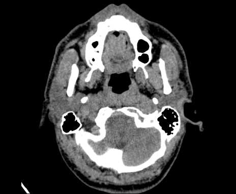 Bilateral carotid body tumors (Radiopaedia 61841-69870 Axial non-contrast 14).jpg