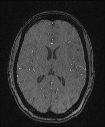 Bilateral carotid body tumors and right glomus jugulare tumor (Radiopaedia 20024-20060 Axial MRA 108).jpg