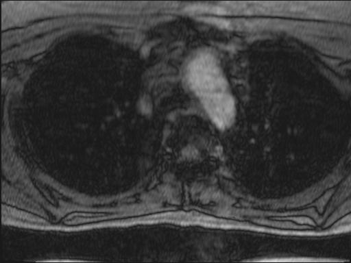 Bilateral carotid body tumors and right glomus jugulare tumor (Radiopaedia 20024-20060 Axial MRA 149).jpg