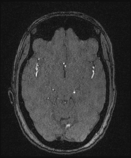 Bilateral carotid body tumors and right glomus jugulare tumor (Radiopaedia 20024-20060 Axial MRA 79).jpg