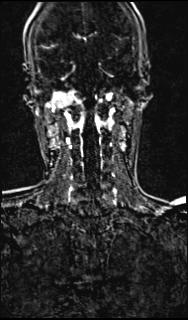 File:Bilateral carotid body tumors and right glomus jugulare tumor (Radiopaedia 20024-20060 MRA 119).jpg