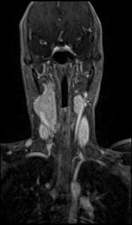 Bilateral carotid body tumors and right glomus jugulare tumor (Radiopaedia 20024-20060 MRA 25).jpg